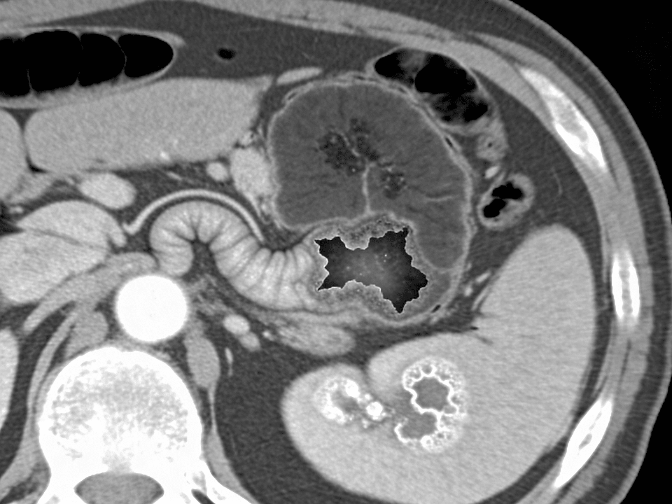 Priority ER surgical team evaluating patient with abdominal CT