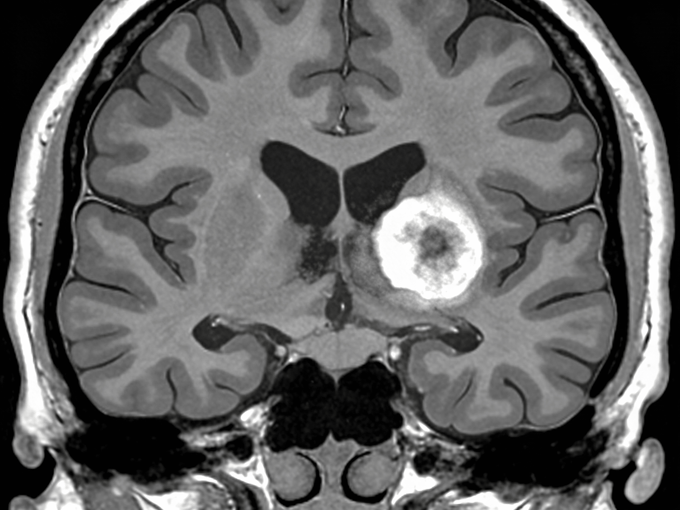 Patient receiving blood pressure monitoring for stroke prevention