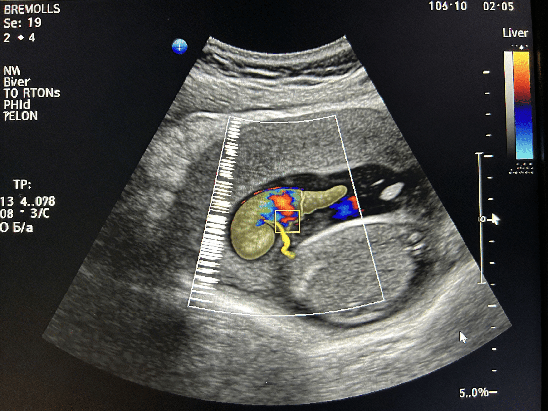 Healthcare provider educating patient about DVT prevention and warning signs